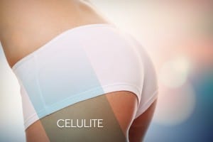 img_sb_celulite2